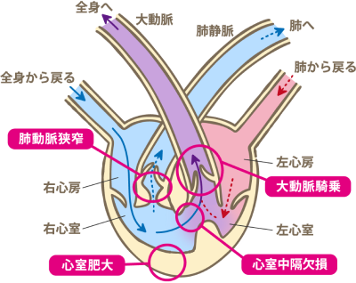 肺の血流量が少ない心疾患_イラスト